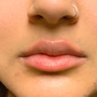 An After photo of Restylane Defyne Lip Filler by PA Nataliya in Seattle, Bellevue, and Kirkland