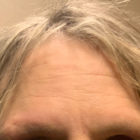 An After photo of Dysport Injections by PA Nataliya in Seattle, Bellevue, and Kirkland