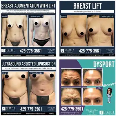 Breast augmentation with lift