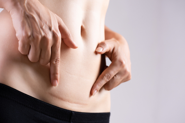 A Photo For A Blog Post About Scar Care In Seattle, Bellevue, and Kirkland