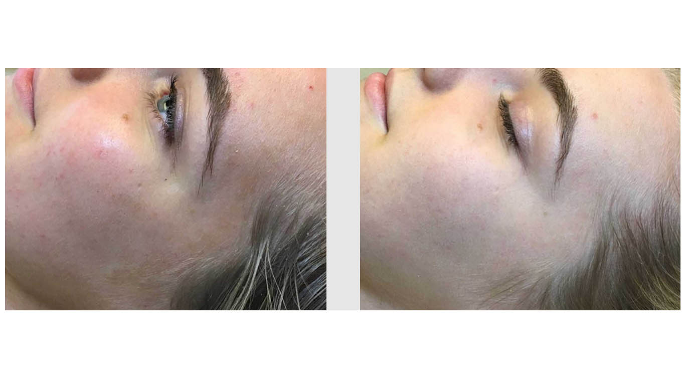 A Before & After of Facials in Bellevue and Kirkland
