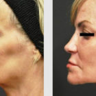 A Before and After photo of an Eyelid Lift Plastic Surgery by Dr. Craig Jonov in Bellevue, Kirkland, and Lynnwood.