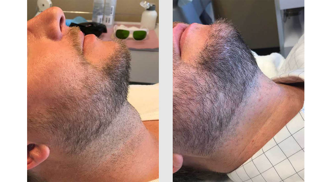 A Before and After photo of Laser Hair Removal by Master Estheticians in Bellevue, Kirkland, and Lynnwood.