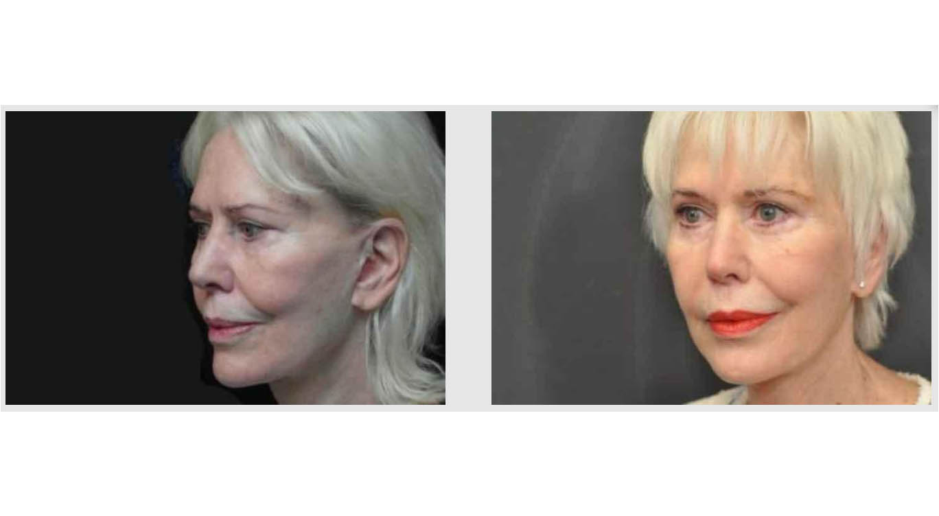 A Before and After photo of Laser Skin Resurfacing by Master Estheticians in Bellevue, Kirkland, and Lynnwood.