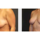 A Before and After photo of a Breast Lift Plastic Surgery by Dr. Craig Jonov in Bellevue, Kirkland, and Lynnwood.