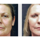 A Before and After photo of an Eyelid Lift Plastic Surgery by Dr. Craig Jonov in Bellevue, Kirkland, and Lynnwood.