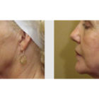 A Before and After photo of a Facelift Plastic Surgery by Dr. Craig Jonov in Bellevue, Kirkland, and Lynnwood.