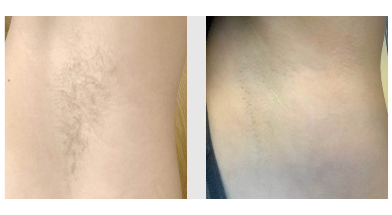 A Before and After photo of Laser Hair Removal by Master Estheticians in Bellevue, Kirkland, and Lynnwood.