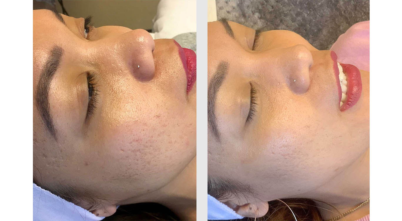 A Before and After photo of Microneedling by Master Estheticians at The Gallery of Cosmetic Surgery in Bellevue, Kirkland, and Lynnwood.