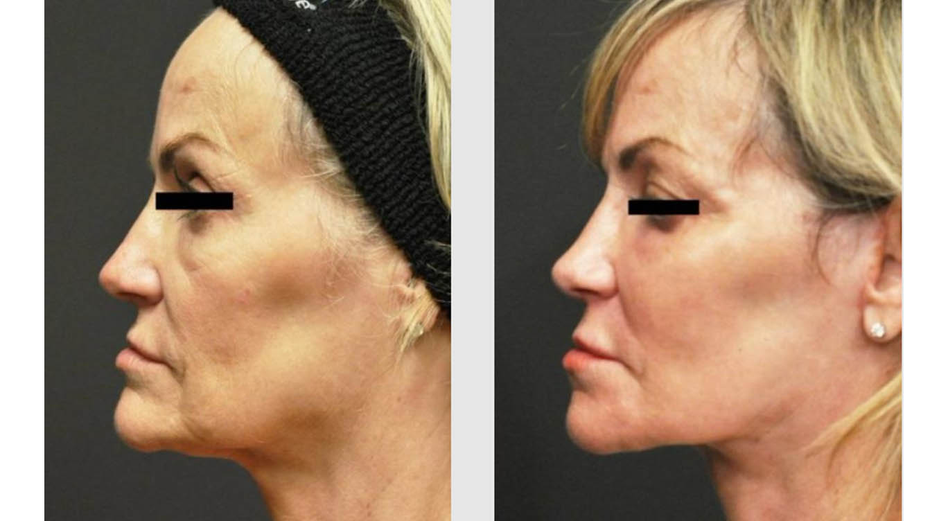 A Before and After photo of a Neck Lift Plastic Surgery by Dr. Craig Jonov in Bellevue, Kirkland, and Lynnwood.