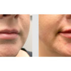 A Before and After photo of Filler injections at The Gallery of Cosmetic Surgery in Bellevue, Kirkland, and Lynnwood.