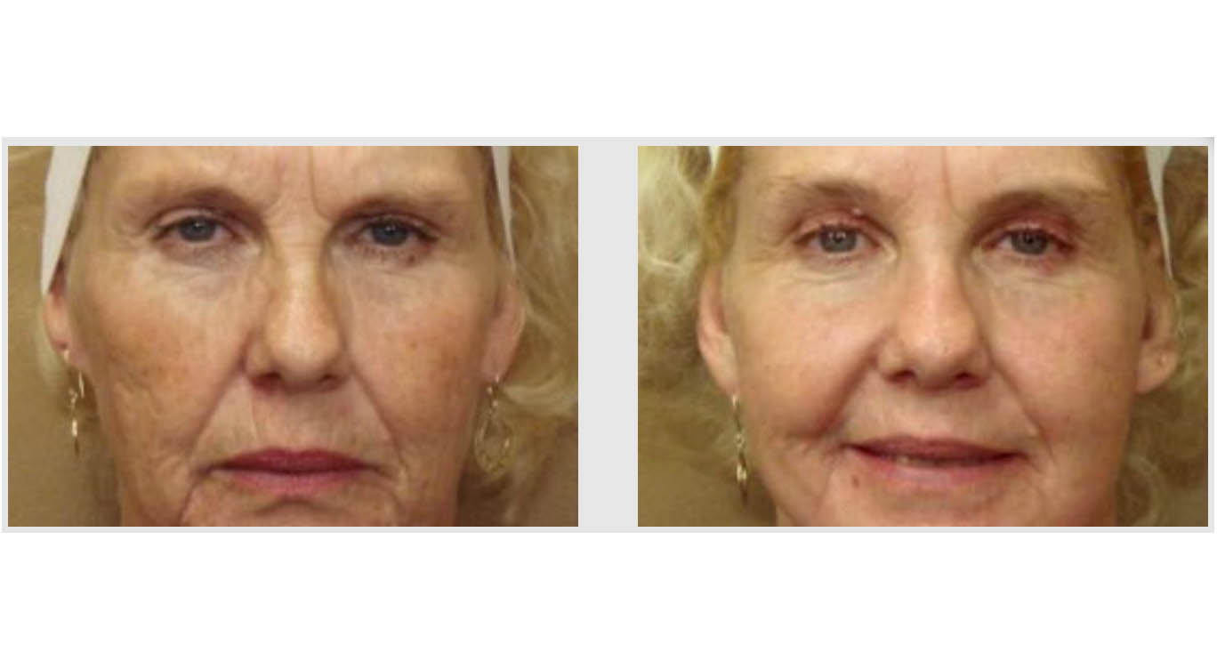 A Before and After photo of Laser Skin Resurfacing by Master Estheticians in Bellevue, Kirkland, and Lynnwood.