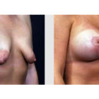 A Before and After photo of a Breast Lift Plastic Surgery by Dr. Craig Jonov in Bellevue, Kirkland, and Lynnwood.