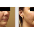 A Before and After photo of a Facelift Plastic Surgery by Dr. Craig Jonov in Bellevue, Kirkland, and Lynnwood.