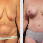 A Before and After photo of a Mommy Makeover Plastic Surgery by Dr. Craig Jonov in Bellevue, Kirkland, and Lynnwood.