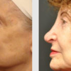 A Before and After photo of an Eyelid Lift Plastic Surgery by Dr. Craig Jonov in Bellevue, Kirkland, and Lynnwood.