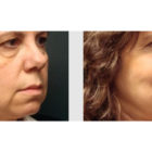 A Before and After photo of a Facelift Plastic Surgery by Dr. Craig Jonov in Bellevue, Kirkland, and Lynnwood.