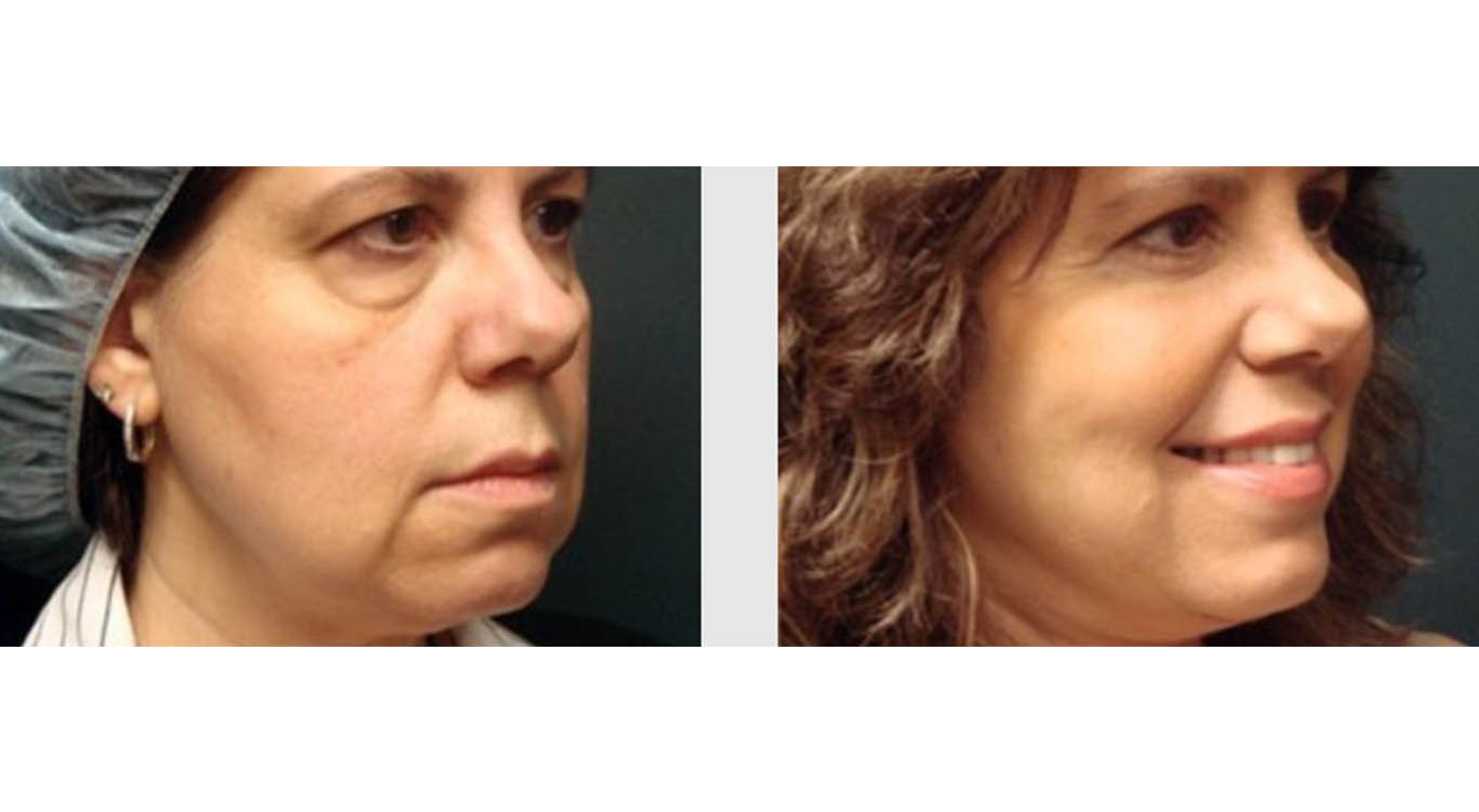 A Before and After photo of a Facelift Plastic Surgery by Dr. Craig Jonov in Bellevue, Kirkland, and Lynnwood.