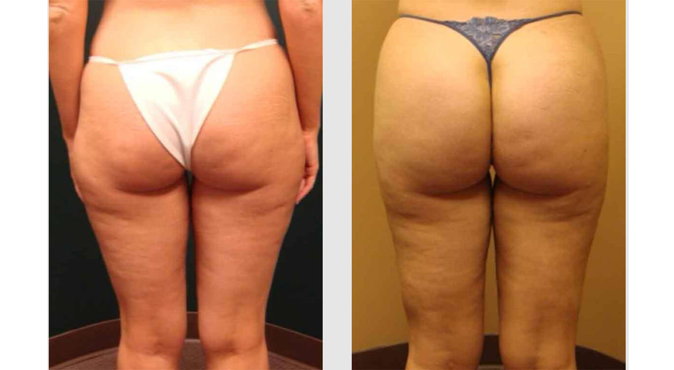 Butt Lift Before and After: Fat Transfers Amazing Results!