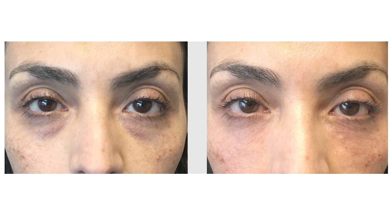 A Before and After photo of Filler injections at The Gallery of Cosmetic Surgery in Bellevue, Kirkland, and Lynnwood.
