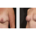 A Before and After photo of a Breast Lift Plastic Surgery by Dr. Craig Jonov in Bellevue, Kirkland, and Lynnwood.