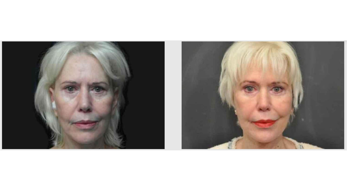 A Before and After photo of Laser Skin Resurfacing by Master Estheticians in Bellevue, Kirkland, and Lynnwood.