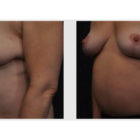 A Before and After photo of a Mommy Makeover Plastic Surgery by Dr. Craig Jonov in Bellevue, Kirkland, and Lynnwood.