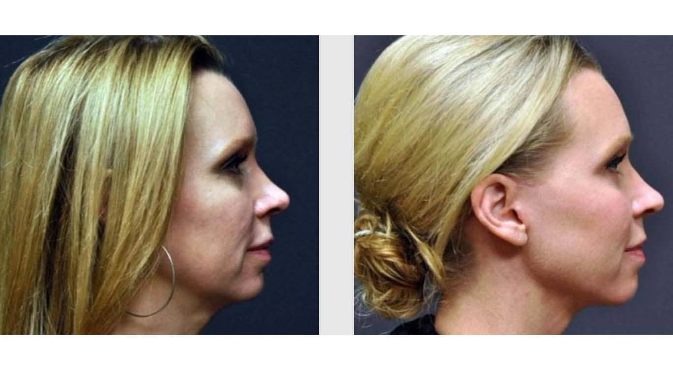 A Before and After photo of a Facelift Plastic Surgery by Dr. Craig Jonov in Bellevue, Kirkland, and Lynnwood.