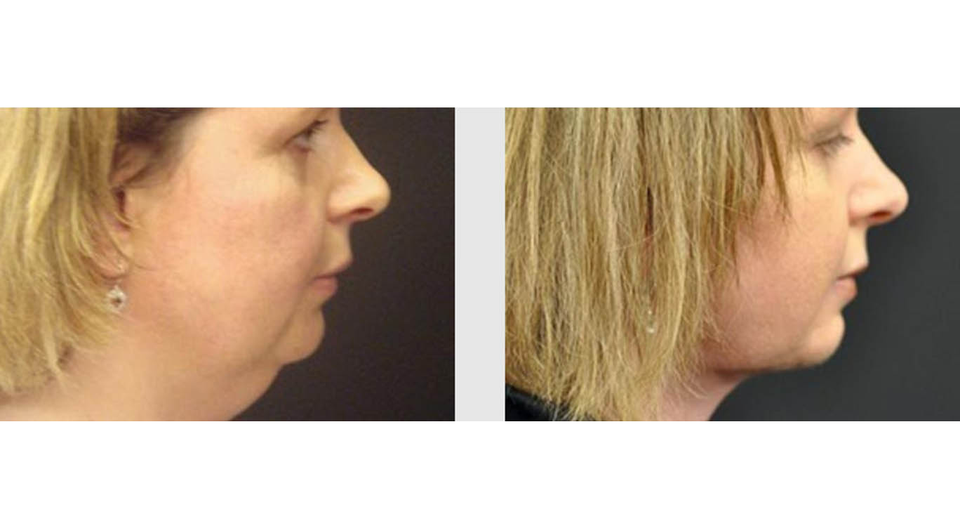 A Before and After photo of a Neck Lift Plastic Surgery by Dr. Craig Jonov in Bellevue, Kirkland, and Lynnwood.