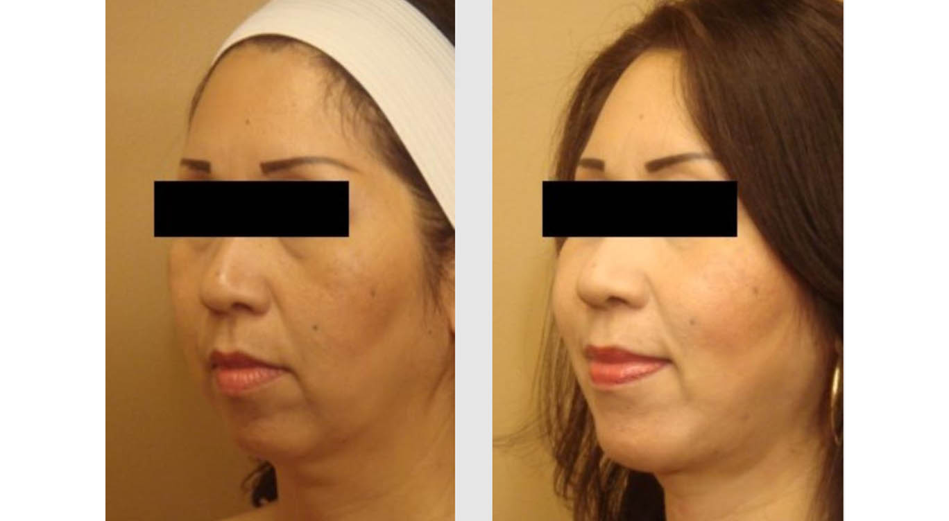 A Before and After photo of a Facelift Plastic Surgery by Dr. Craig Jonov in Bellevue, Kirkland, and Lynnwood.