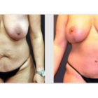 A Before and After photo of a Mommy Makeover Plastic Surgery by Dr. Craig Jonov in Bellevue, Kirkland, and Lynnwood.
