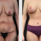 A Before and After photo of a Mommy Makeover Plastic Surgery by Dr. Craig Jonov in Bellevue, Kirkland, and Lynnwood.