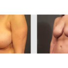 A Before and After photo of a Breast Lift Plastic Surgery by Dr. Craig Jonov in Bellevue, Kirkland, and Lynnwood.