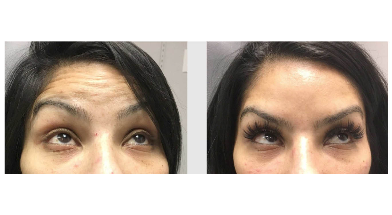 A Before and After photo of BOTOX injections at The Gallery of Cosmetic Surgery in Bellevue, Kirkland, and Lynnwood.