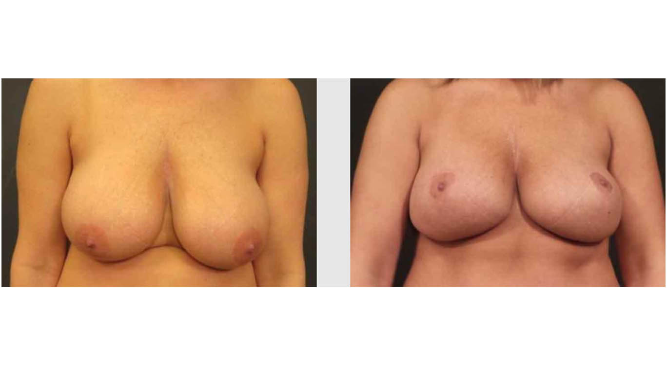 A Before and After photo of a Breast Lift Plastic Surgery by Dr. Craig Jonov in Bellevue, Kirkland, and Lynnwood.