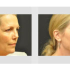 A Before and After photo of a Facelift Plastic Surgery by Dr. Craig Jonov in Bellevue, Kirkland, and Lynnwood.