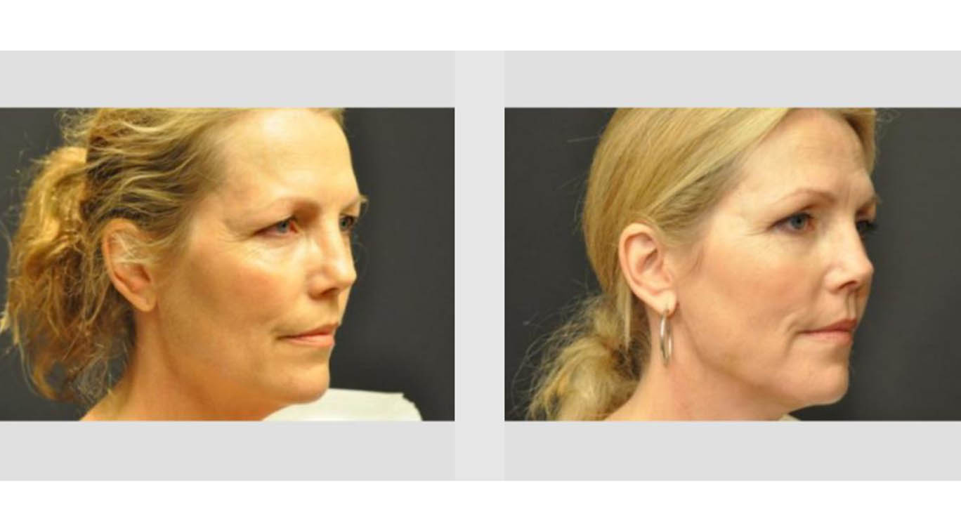 A Before and After photo of a Facelift Plastic Surgery by Dr. Craig Jonov in Bellevue, Kirkland, and Lynnwood.
