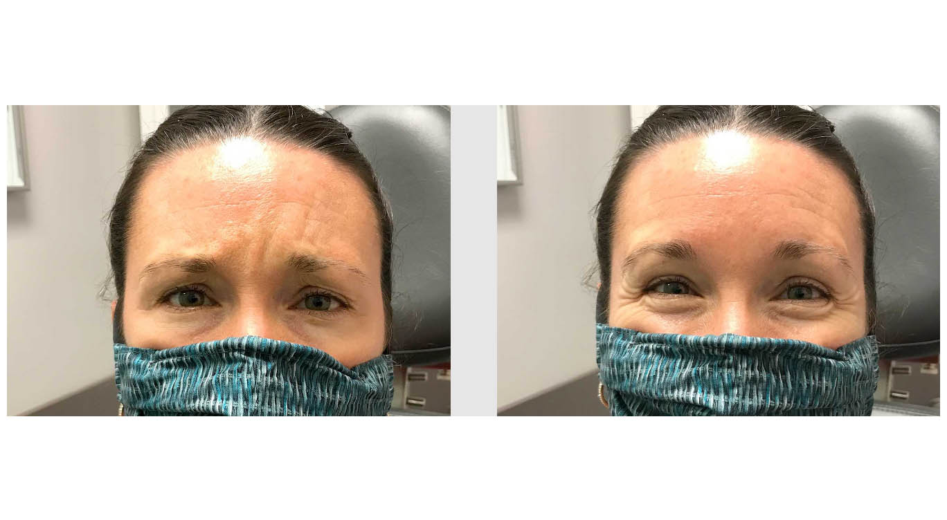A Before and After photo of BOTOX injections at The Gallery of Cosmetic Surgery in Bellevue, Kirkland, and Lynnwood.