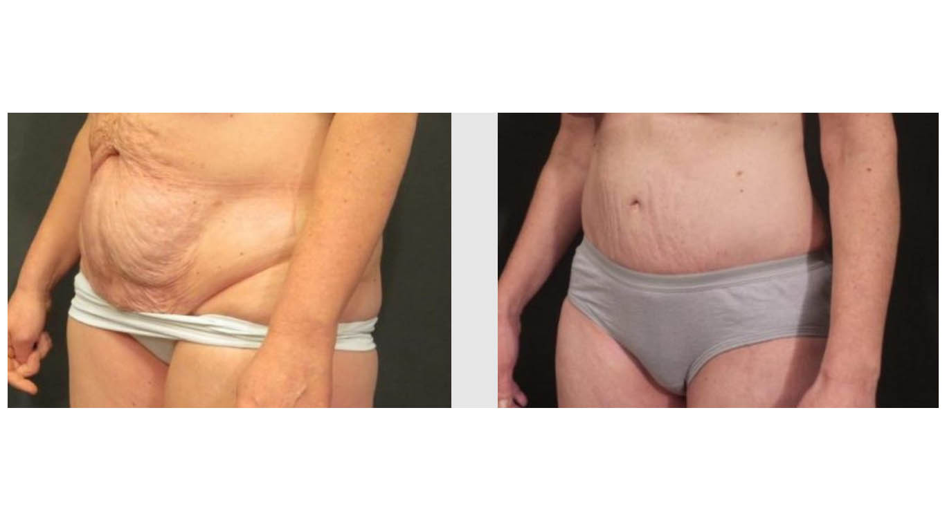 A Before & After Photo of a Mons Pubis Lift by Dr. Craig Jonov in Bellevue and Kirkland