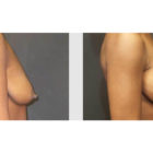 A Before and After photo of a Breast Lift Plastic Surgery by Dr. Craig Jonov in Bellevue, Kirkland, and Lynnwood.