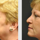 A Before and After photo of an Eyelid Lift Plastic Surgery by Dr. Craig Jonov in Bellevue, Kirkland, and Lynnwood.