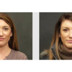 A Before and After photo of a Nose Job Plastic Surgery by Dr. Craig Jonov Bellevue, Kirkland, and Lynnwood.