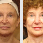 A Before and After photo of a Facelift Plastic Surgery by Dr. Craig Jonov in Bellevue, Kirkland, and Lynnwood.