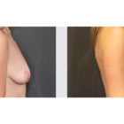 A Before and After photo of a Breast Lift Plastic Surgery by Dr. Craig Jonov in Bellevue, Kirkland, and Lynnwood.