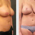 A Before and After photo of a Mommy Makeover Plastic Surgery by Dr. Craig Jonov in Bellevue, Kirkland, and Lynnwood.