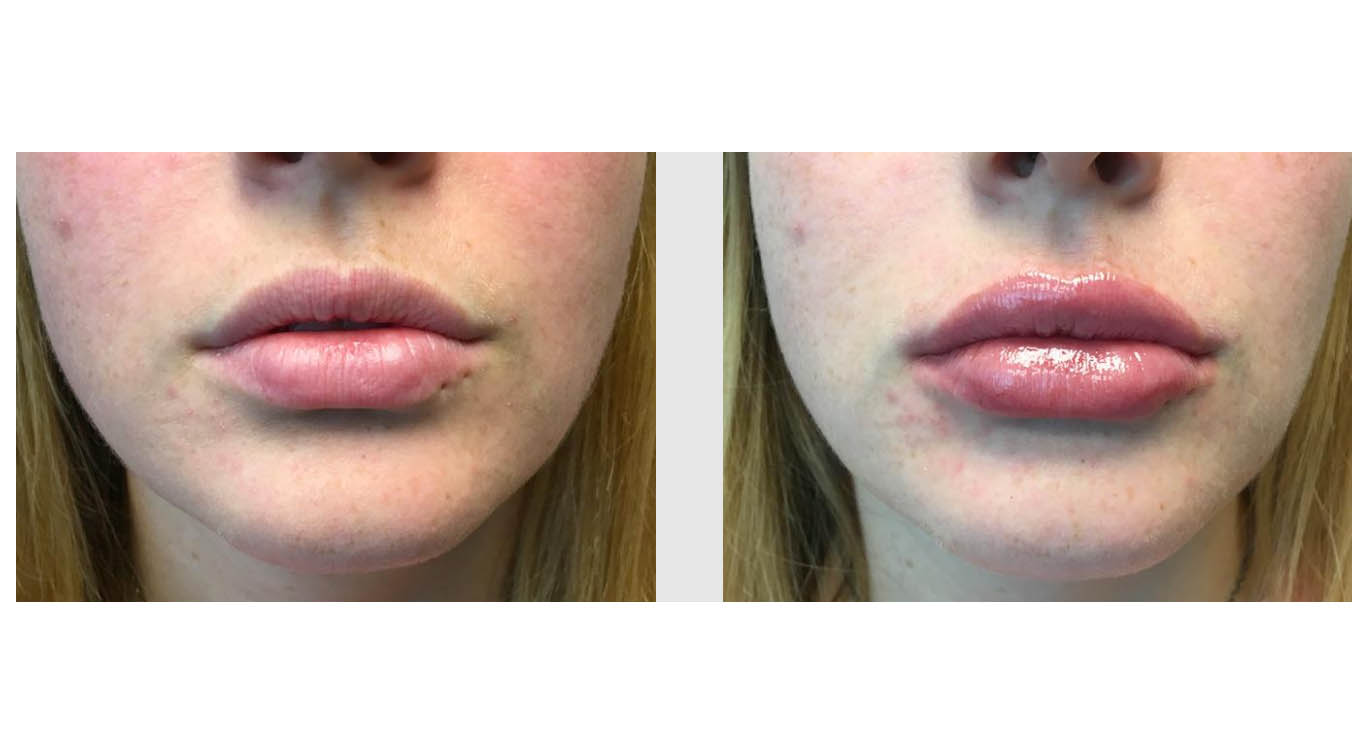 A Before and After photo of Filler injections at The Gallery of Cosmetic Surgery in Bellevue, Kirkland, and Lynnwood.