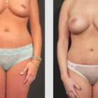 A Before and After photo of a Mommy Makeover Plastic Surgery by Dr. Craig Jonov in Bellevue, Kirkland, and Lynnwood.