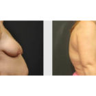 A Before and After photo of a Breast Lift Plastic Surgery by Dr. Craig Jonov in Bellevue, Kirkland, and Lynnwood.