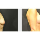 A Before and After photo of a Breast Lift Plastic Surgery by Dr. Craig Jonov in Bellevue, Kirkland, and Lynnwood.