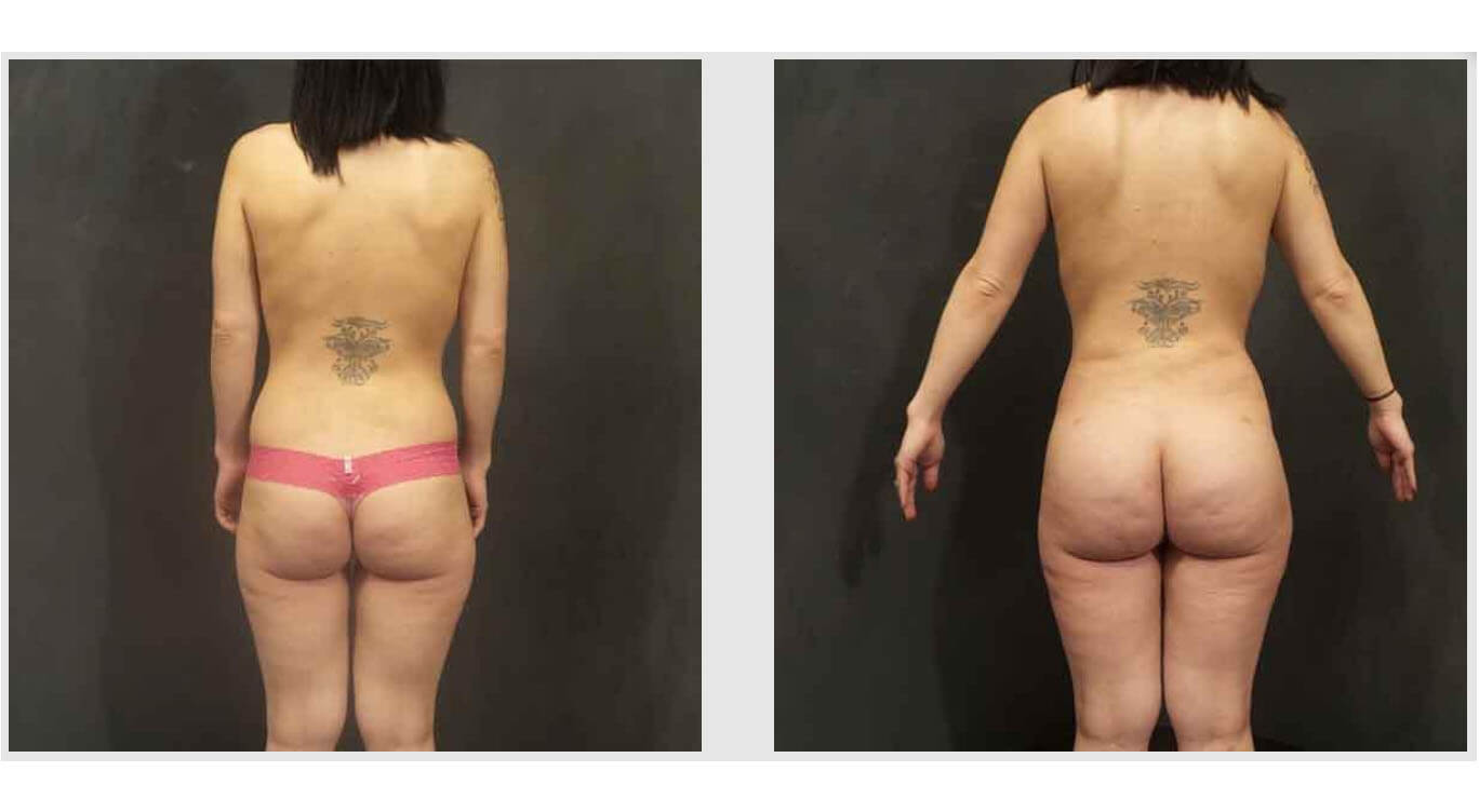 A Before and After photo of a Brazilian Butt Lift Plastic Surgery by Dr. Craig Jonov in Bellevue, Kirkland, and Lynnwood